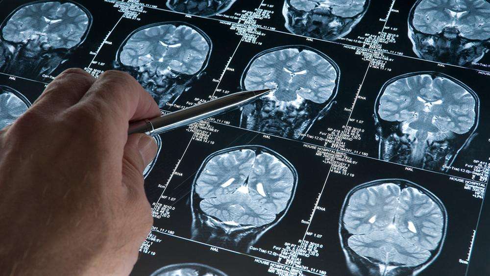 Araştırma: Alzheimer düşünüldüğünden daha erken başlayabilir